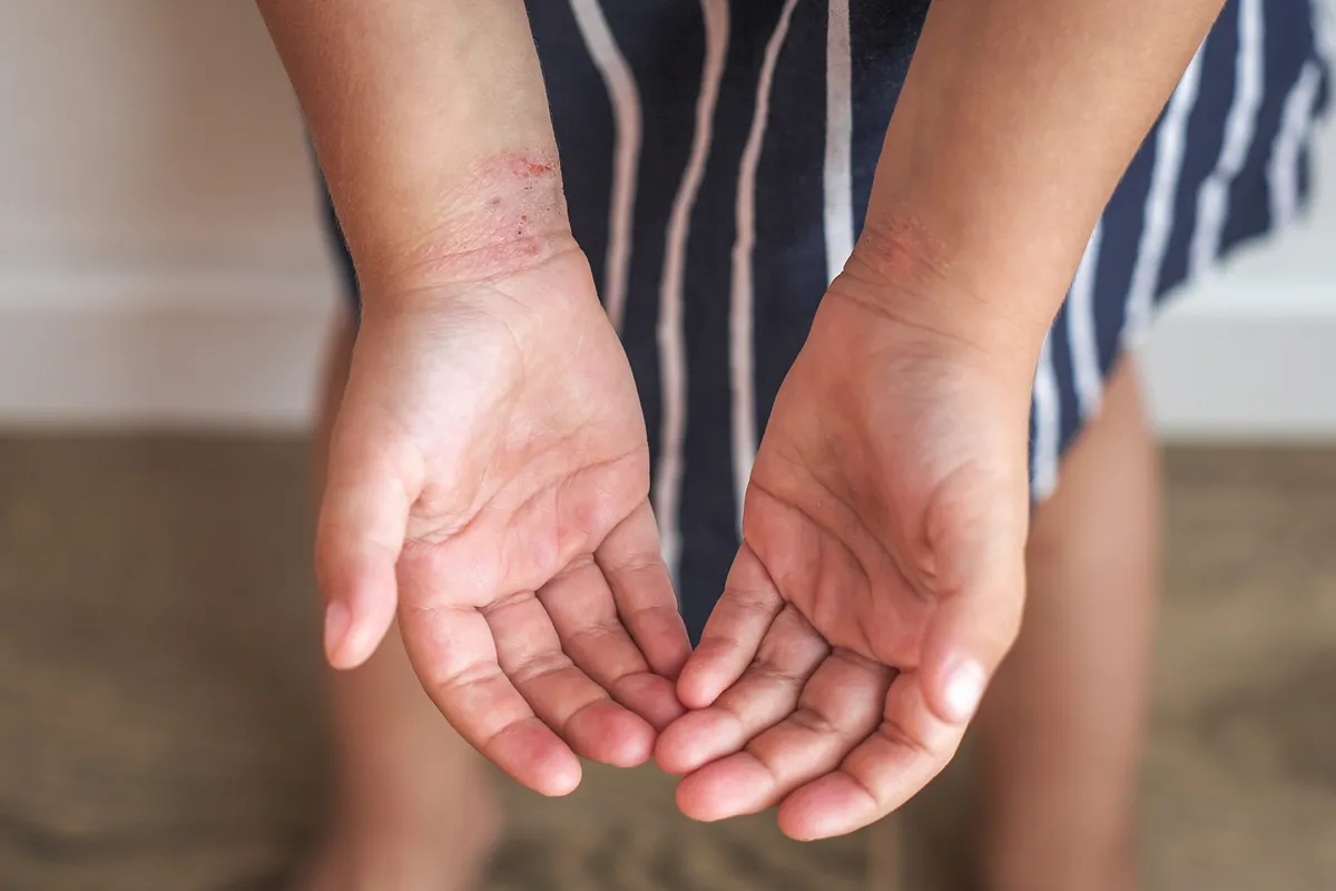 Child holding out hands to show a rash on the wrist